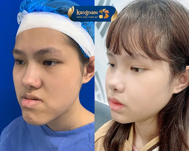 Gương mặt cân đối, thanh tú hơn sau khi sửa hàm móm