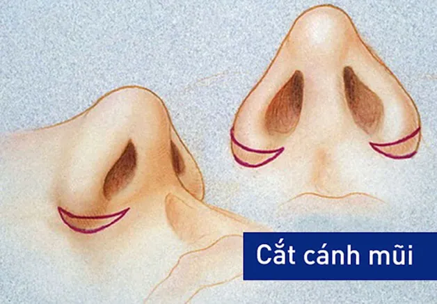 Thu gọn cánh mũi là tiểu phẫu đơn giản, giúp loại bỏ phần cánh mũi to bè và tạo cánh mũi gọn