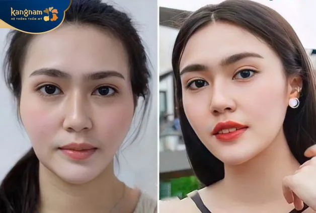 Trẻ hóa lên đến 10 tuổi sau cấy mỡ Bio Fat