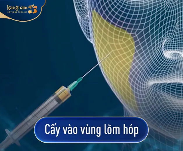 Tiến hành cấy mỡ làm đầy vùng lõm, hóp
