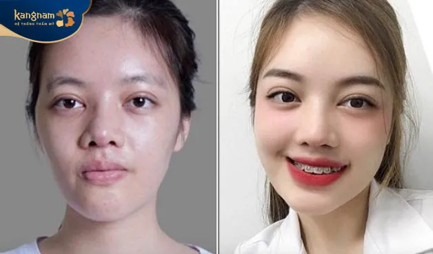 Gương mặt rạng rỡ, tươi trẻ sau cấy mỡ