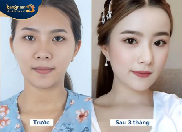 3 tháng sau cấy mỡ gương mặt có sự thay đổi rõ rệt
