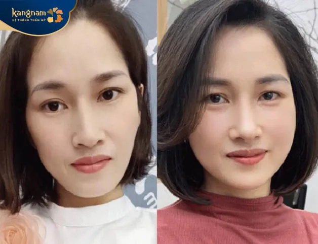 Mặt hóp, hốc hác được cải thiện