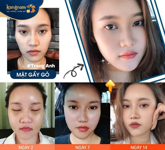 Quá trình phục hồi sau cấy mỡ