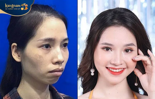 Gương mặt đầy đặn sau cấy mỡ