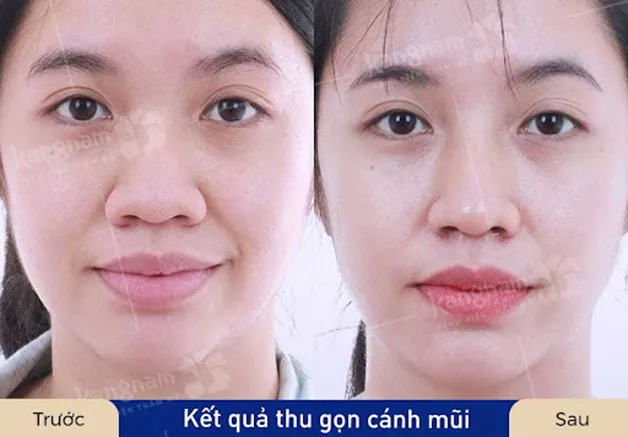 Kết quả thu nhỏ cánh mũi đẹp không tì vết