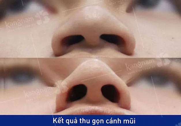Thu nhỏ cánh mũi tạo hiệu ứng đẩy sống mũi lên ca, mang lại dáng mũi thon gọn