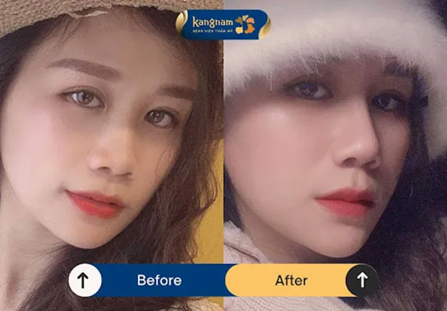 Các nét trên gương mặt nổi bật hơn sau khi nâng mũi tại Kangnam