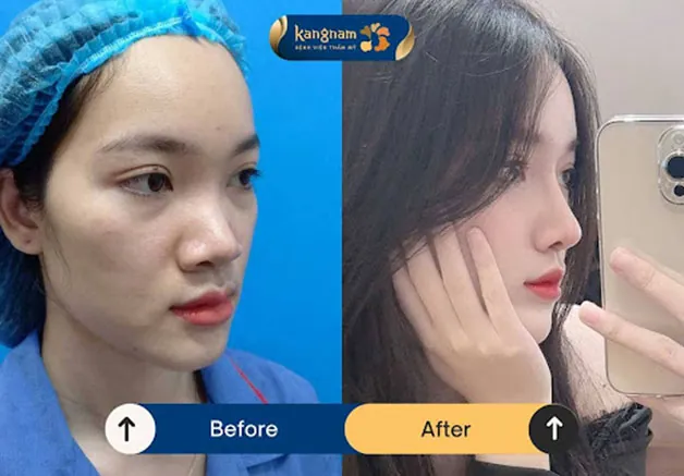 Góc nghiêng thần thánh sau khi chỉnh sửa dáng mũi