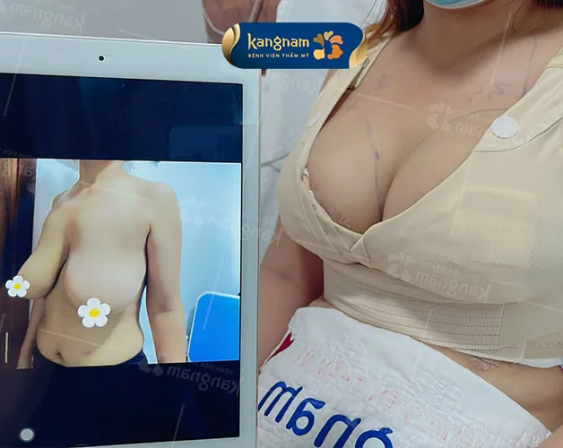 Treo ngực sa trễ tại Kangnam