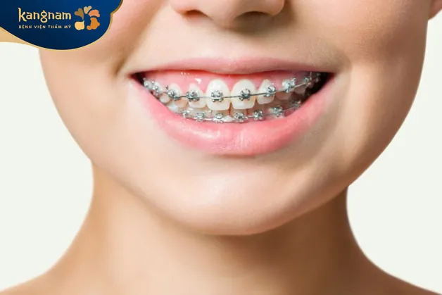 Niềng răng là cách sửa mặt lệch hiệu quả