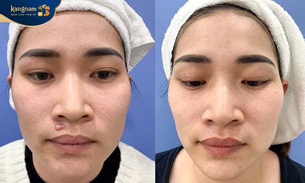 Sẹo lồi ở môi được là phẳng khi điều trị tại Kangnam