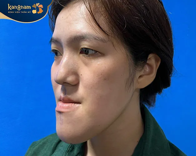 Hàm dưới bị đưa ra nhiều hơn so với hàm trên, khu vực cằm nhô ra phía trước