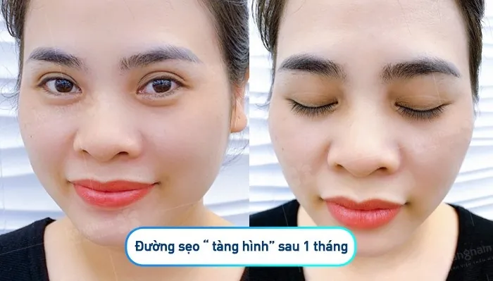 Đường sẹo "tàng hình" sau 1 tháng thẩm mỹ trẻ hóa mắt