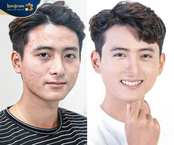 Trị sẹo tai Kangnam mang lại kết quả tối ưu