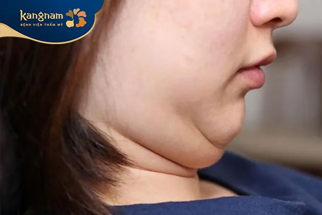 Người có mỡ tích tụ nhiều ở nọng cằm, khó giảm bằng ăn kiêng, tập luyện nên cân nhắc hút mỡ