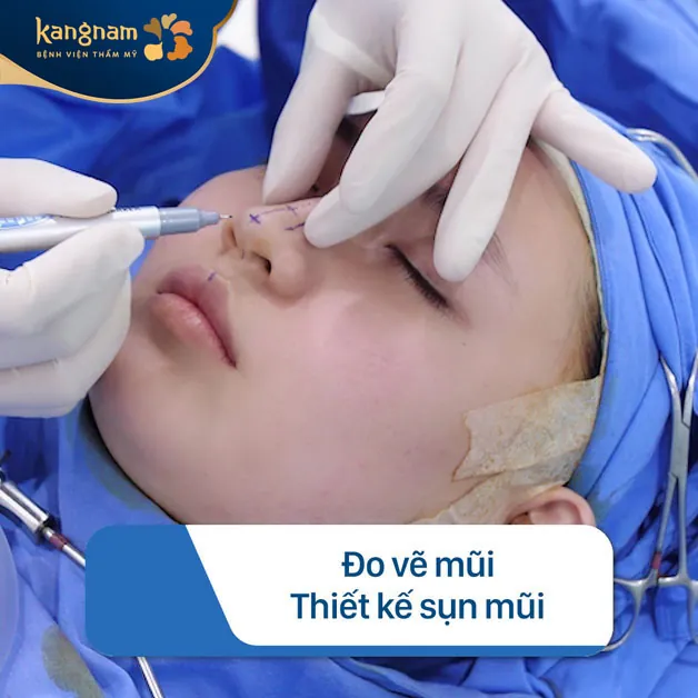 Đo vẽ các điểm cần can thiệp để chuẩn bị thiết kế sụn mũi