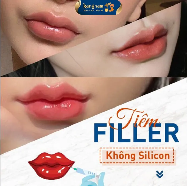 Tiêm filler Hàn Quốc được đánh giá là an toàn. Sau khi tiêm đôi môi căng mọng, quyến rũ tự nhiên 