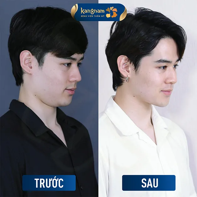 Tự tin với gương mặt thon gọn và trẻ trung sau khi giảm mỡ