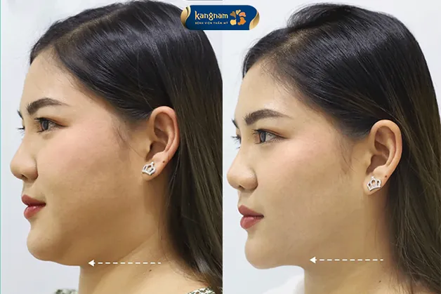 Thăng hạng nhan sắc, trẻ ra đến 5 tuổi sau khi giảm mỡ