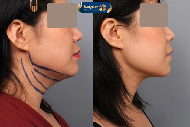 Cải thiện đường nét khuôn mặt trở nên mảnh mai