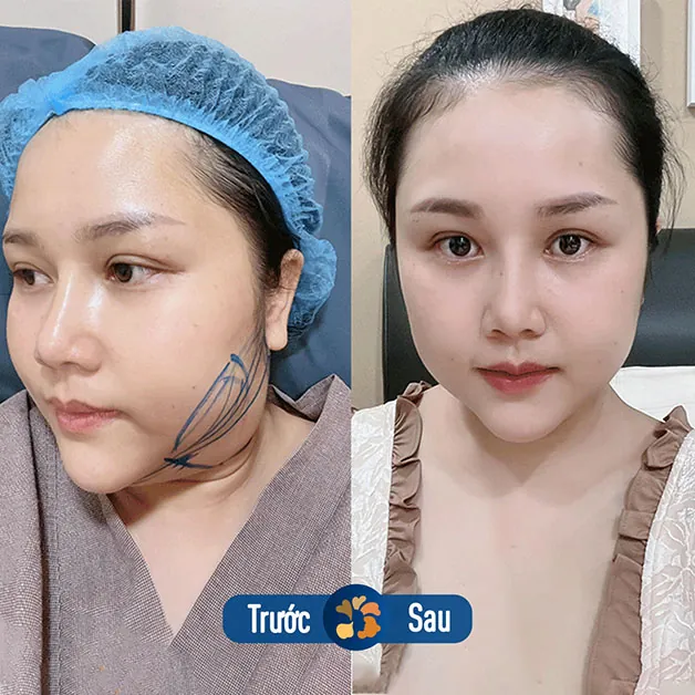 Gương mặt thon gọn hơn sau khi giảm mỡ nọng cằm