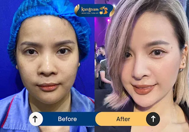 Nâng mũi thay đổi cấu trúc mũi toàn diện