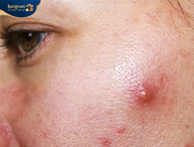Mụn có kích thước lớn, sưng đỏ, phần nhân mụn nằm sâu dưới da
