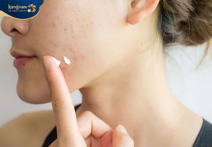 Có thể sử dụng thuốc bôi không kê đơn để trị mụn