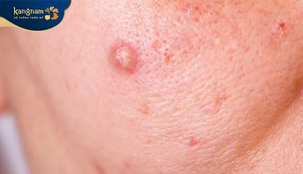 Mụn bọc ở má có kích thước lớn, sưng đỏ và gây đau nhức