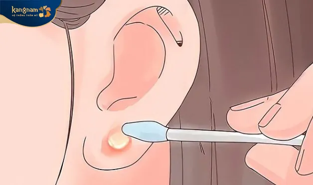 Viêm nhiễm sau xỏ khuyên làm hình thành mụn bọc 