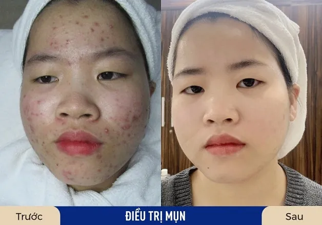 Nguyễn Ánh thay đổi rõ rệt sau 4 buổi điều trị