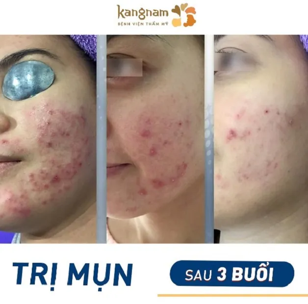 Sau 3 buổi điều trị da đã ổn hơn