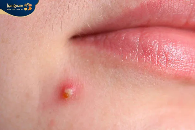 Mụn mủ trắng là loại mụn rất nguy hiểm