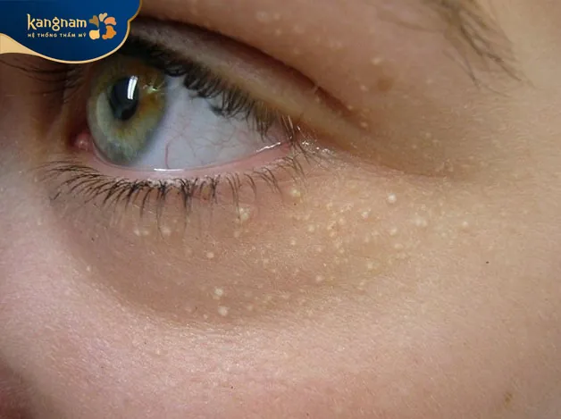 collagen thay đổi làm hình thành mụn thịt