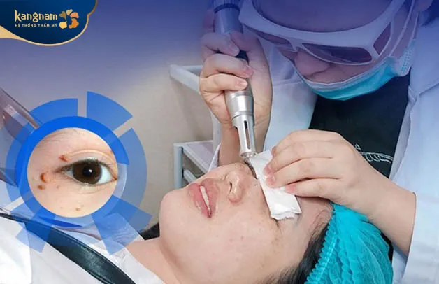 Liệu pháp laser điều trị mụn thịt được đánh giá cao về mức độ hiệu quả và an toàn