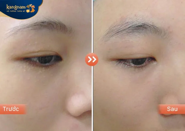 Mụn thịt quanh mắt "Sạch bong" chỉ sau đúng 1 lần laser