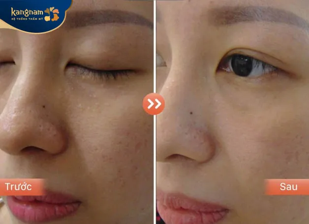 Sau 1 tuần, vùng điều trị mụn thịt đã phục hồi