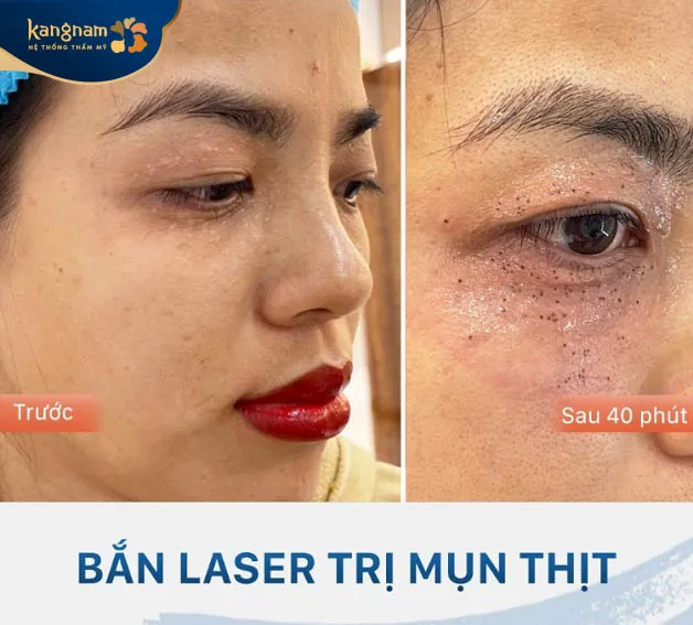 Khách hàng chia sẻ không có cảm giác đau đớn, khó chịu sau điều trị mụn thịt