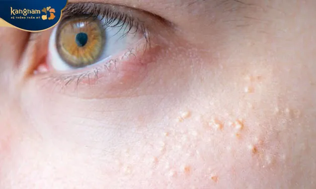 Có nhiều nguyên nhân dẫn đến tình trạng mụn thịt thừa