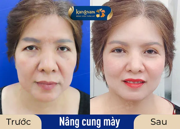 Khách hàng trẻ ra nhiều tuổi sau khi nâng cung mày