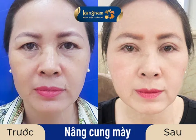 Gương mặt trở nên rạng rỡ hơn sau khi treo cung mày