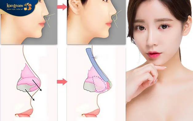 Sụn nâng mũi tạo hình dáng mũi đẹp tự nhiên, hài hòa với gương mặt