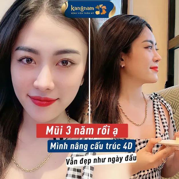 Mũi bền đẹp sau 3 năm của chị khách xinh đẹp