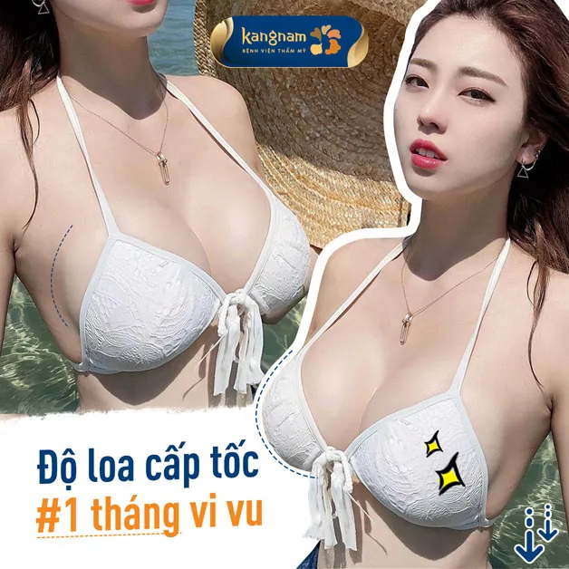 Tự tin với vòng 1 hoàn hảo, thoải mái vi vu sau 1 tháng nâng ngực