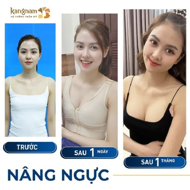 Chị Huyền Giang chia sẻ hình ảnh sau khi nâng ngực