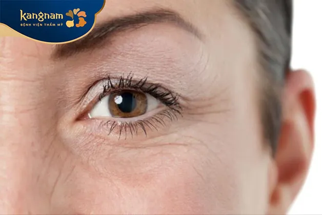 Vùng da quanh chân mày bị sụp xuống do da chùng, lão hóa