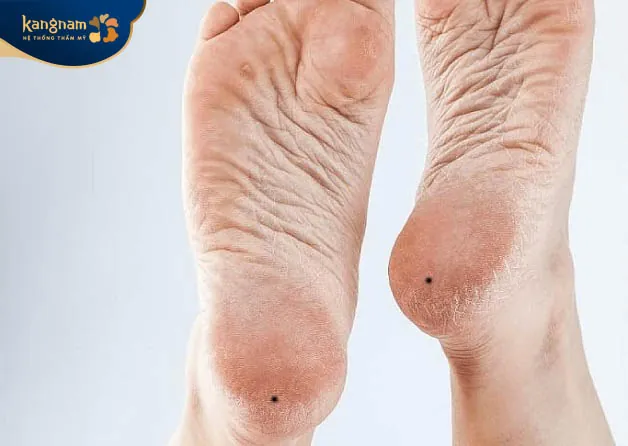 Nốt ruồi lòng bàn chân nam giới