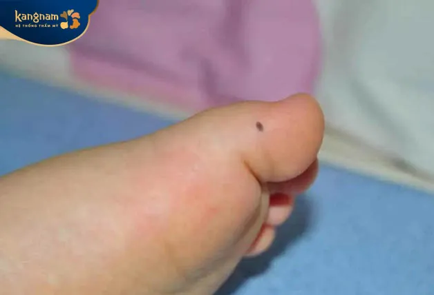 Nốt ruồi ở ngón chân cái