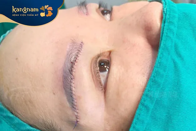 Treo cung mày nhờ phẫu thuật